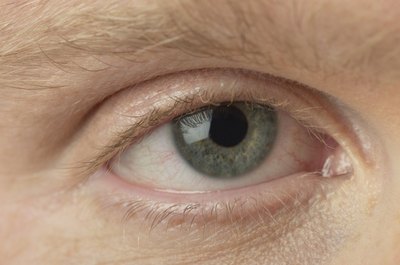 HPV can cause warts on eyelids.