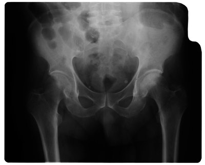 xray of tailbone