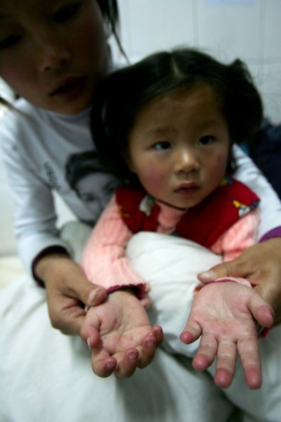 Two year old girl with hand, foot, and mouth disease