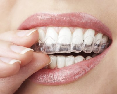 The active ingredient in whitening strips bleaches your teeth to a whiter color.