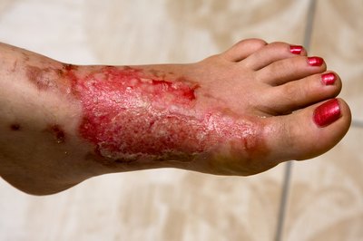 Third-degree burns are the worst and require a doctor's care.
