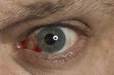 A mold infection of the eye can lead to watery eyes, a pink or reddish appearance and itchiness