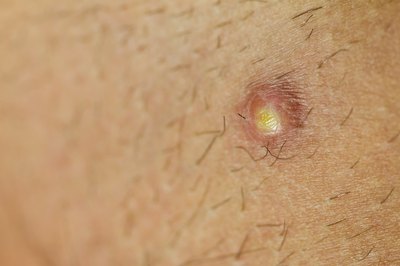 The bumps may have whiteheads that itch and can get infected when scratched.