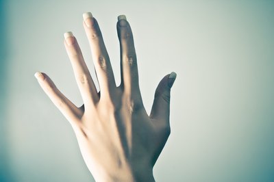 Psoriasis can affect your nails