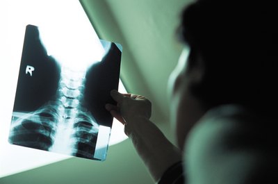 Spinal conditions causing hand, arm and shoulder pain usually affect your cervical spine.