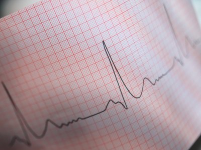 EKG chart