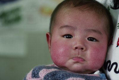 flushed face of child