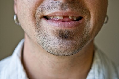 Missing teeth.