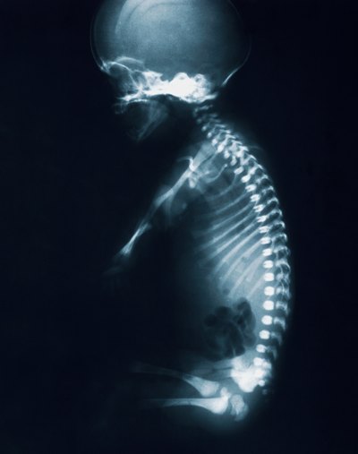 A healthy spine should have a slight "S" curve.
