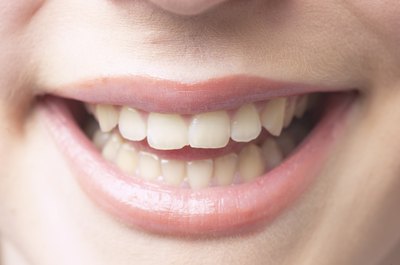 Your dentist may be able to fix the tooth so that the chips are not noticeable.