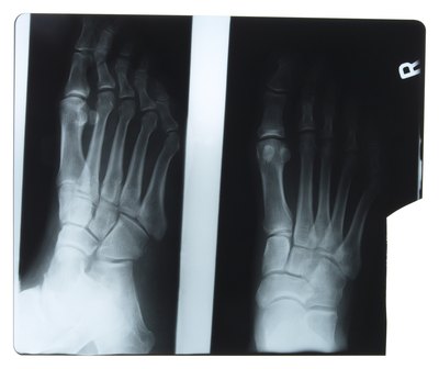 The long bones of the foot.