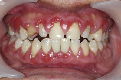 Gum disease.