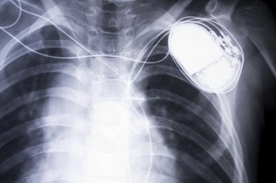 Pacemaker x-ray