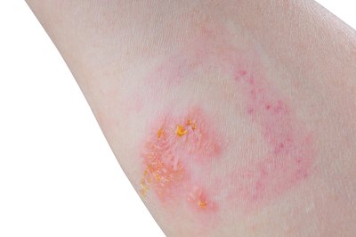 A poison ivy rash.