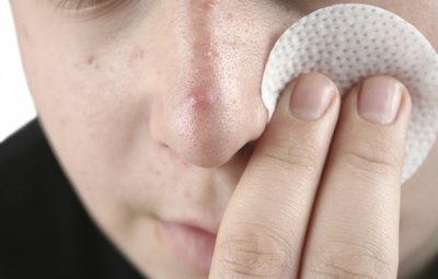 This supplement can be used to treat acne.