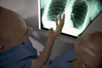 According to the National Institutes of Health (NIH), pulmonary edema (water in the lungs) is caused by fluid building up in the air sacs of the lungs.