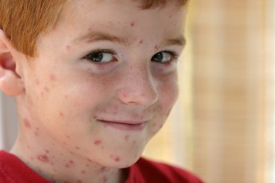 A child with chicken pox.