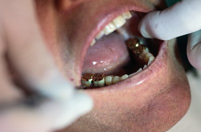 A crown on patient's tooth.