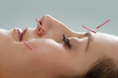 Acupuncture is gaining popularity in relieving back pain.