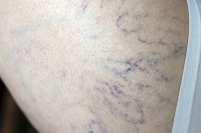 Spider veins.