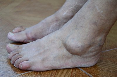 Close up of severely swollen feet