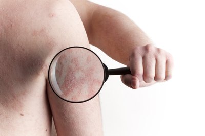 Psoriasis all over body.