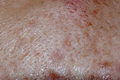 Dermatitis.