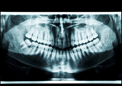 Teeth x-ray.