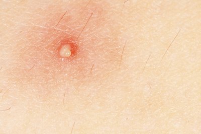 Boil on skin.
