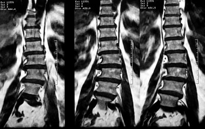 MRI of lumbar spinal scoliosis.