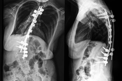 X-rays of a spine with scoliosis.