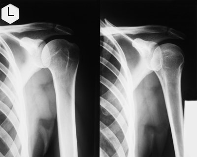 The supraspinatus is one of the major muscles of the rotator cuff.