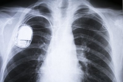 X-ray of human chest with pacemaker installed.