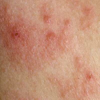 Rashes are sometimes caused by stress.