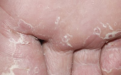 Skin may become dry with this condition.