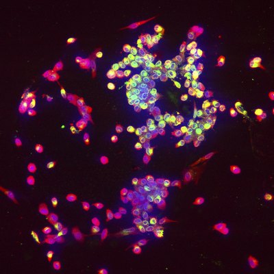 activated lymphocytes attacking foreign bodies
