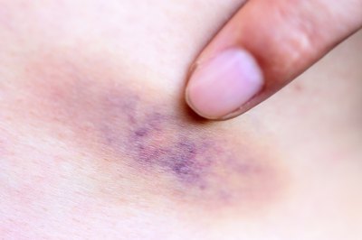 Bruise on leg.