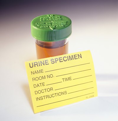 One of the most common tests is a urinalysis.