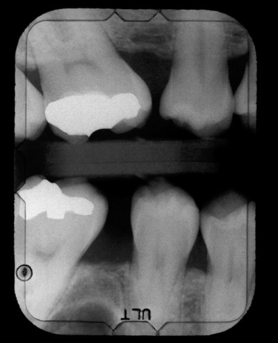 Dental x-ray showing cavities and fillings