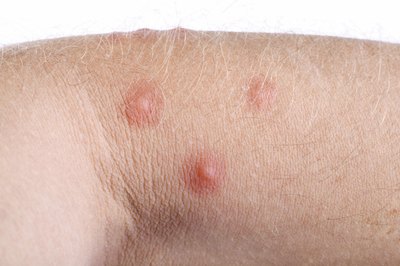 Staph can arise from skin infections, food poisoning, blood infections and toxic shock