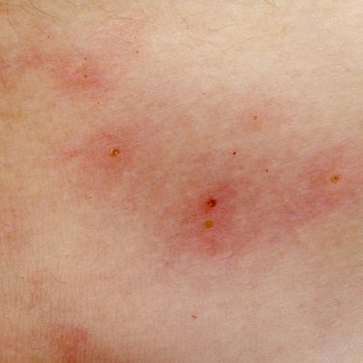 Chlorine is a skin irritant which can cause a rash if a swimmer is repeatedly exposed to chlorinated water