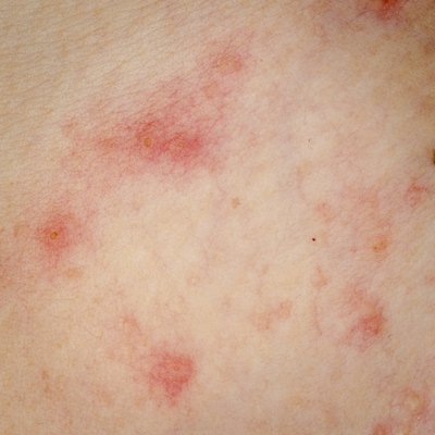Allergic rash on skin.