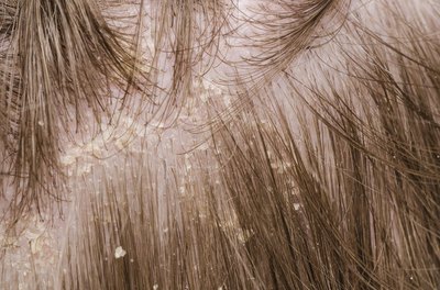 Psoriasis on scalp.