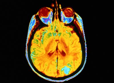 Brain scan showing presence of cancer