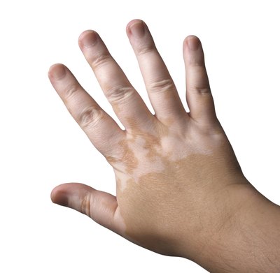 People with autoimmune conditions are at higher risk.