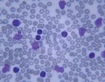 Leukemia is a form of cancer. White blood cells are overproduced in the bone marrow and ultimately begin to overtake red blood cells.