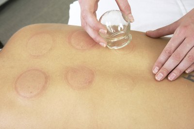 Cupping.