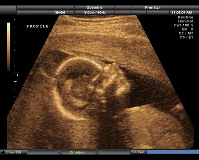 Ultrasound Image of baby