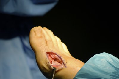 After conservative treatments fail, your physician may decide to perform a bunionectomy.