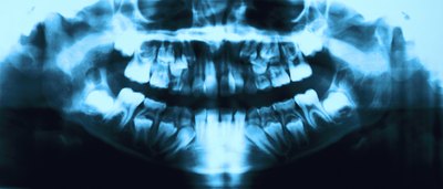 The first, second or wisdom teeth can erupt sooner than usual.
